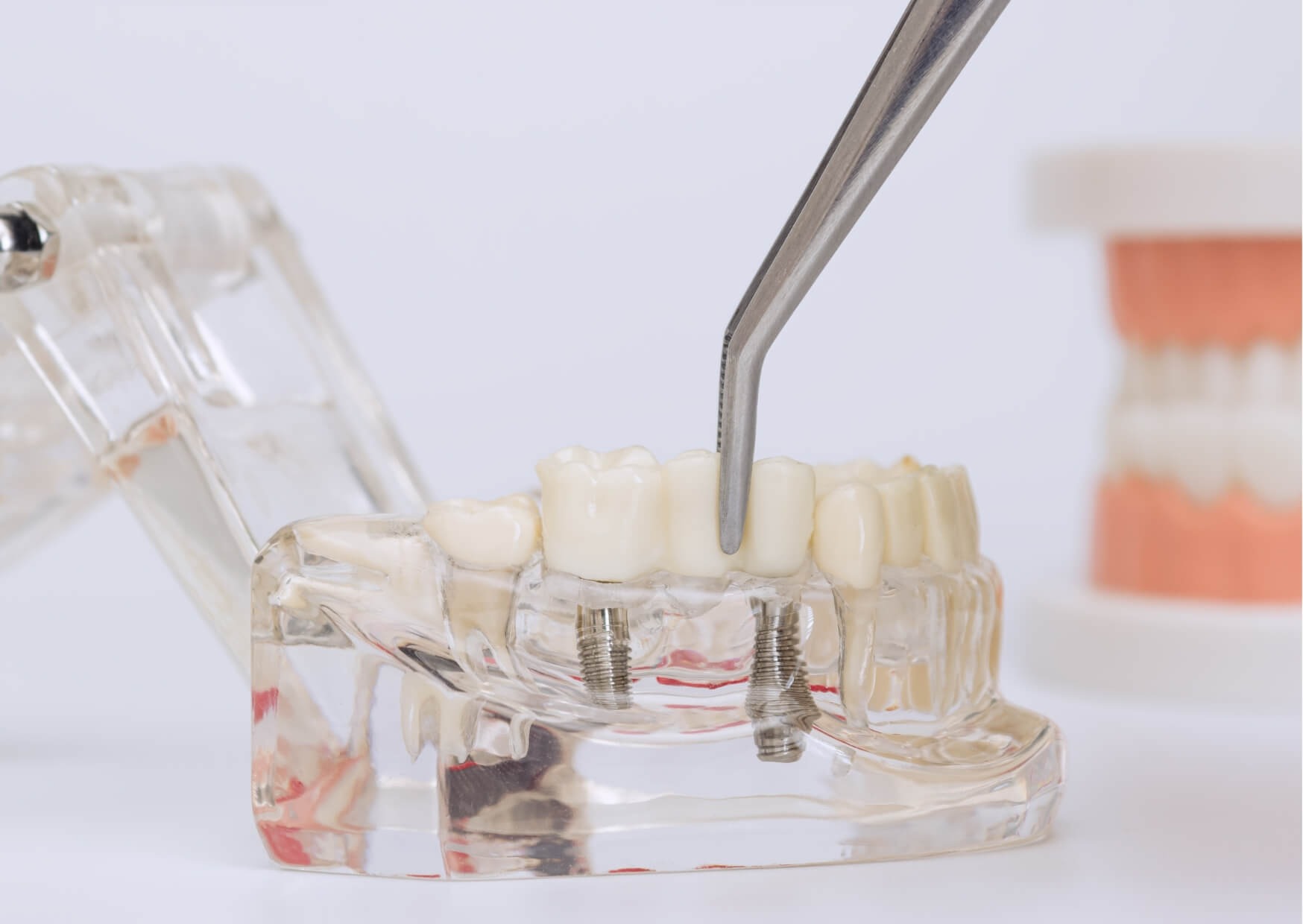 Close-up dental implant model showing implant placement and restoration used to discuss dental implant pros and cons